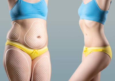 Liposuction-in-Riyadh-11