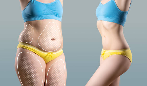 Liposuction Surgery in Riyadh