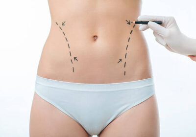 Liposuction-surgery-in-Riyadh-21
