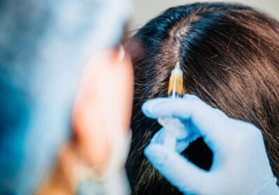 PRP-Hair-Treatment-in-Riyadh-7