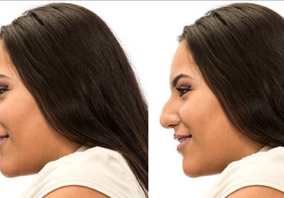 عملية-تجميل-الأنف-في-الرياض-21