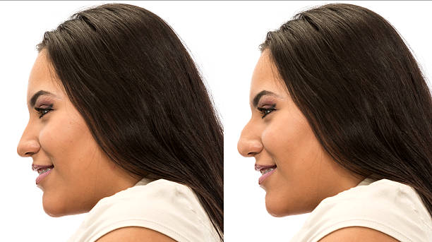 The cost of rhinoplasty in Saudi Arabia