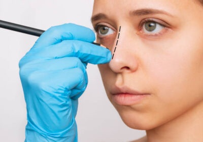 عملية-تجميل-الأنف-في-الرياض-36