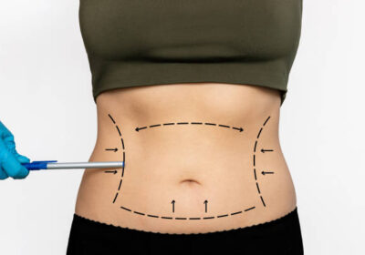 عملية-شفط-الدهون-في-الرياض-14