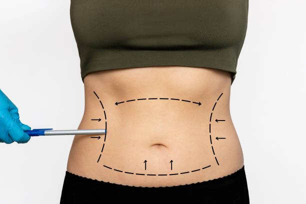 Liposuction in Riyadh