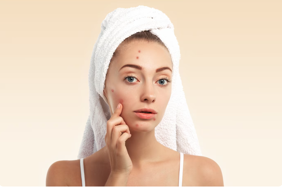 10 Tips Para Mawala ang Pimples – Proven Ways for Clea