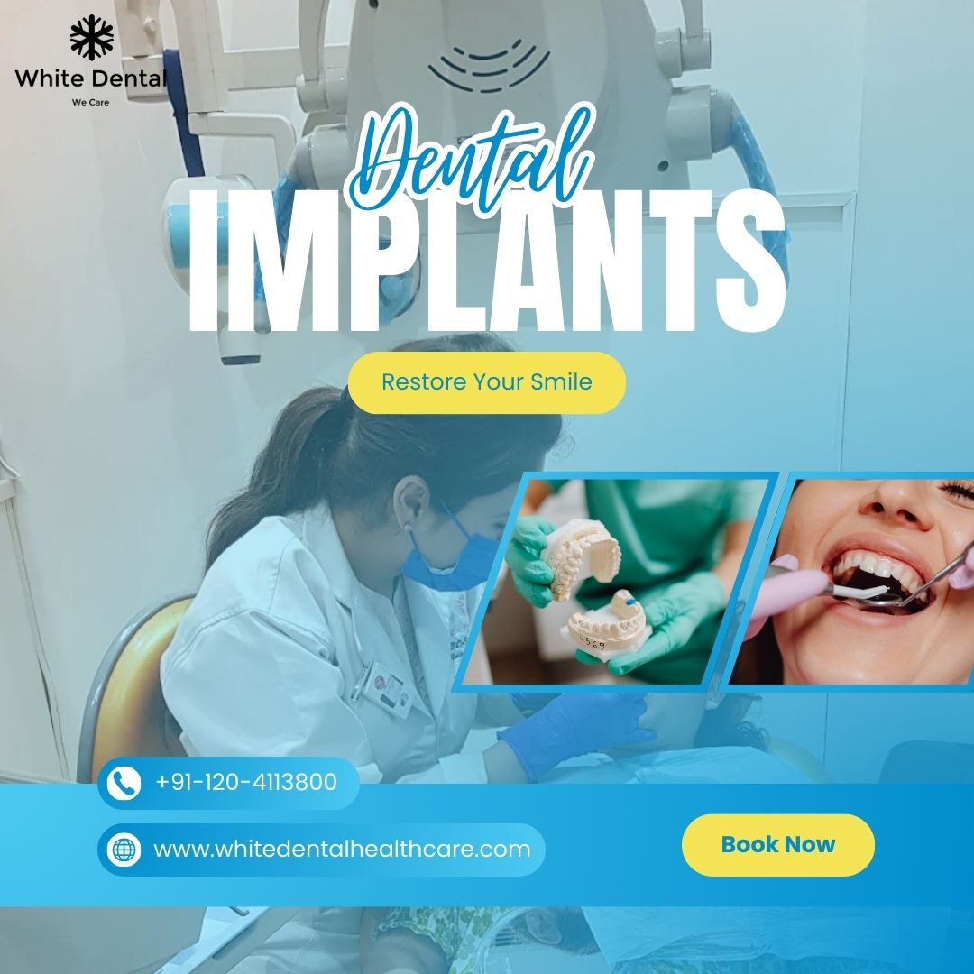 Dental implants in Indirapuram for long-lasting tooth