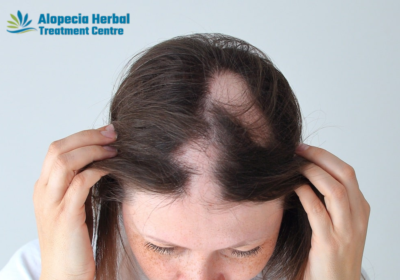 Alopecia-Areata-Treatment