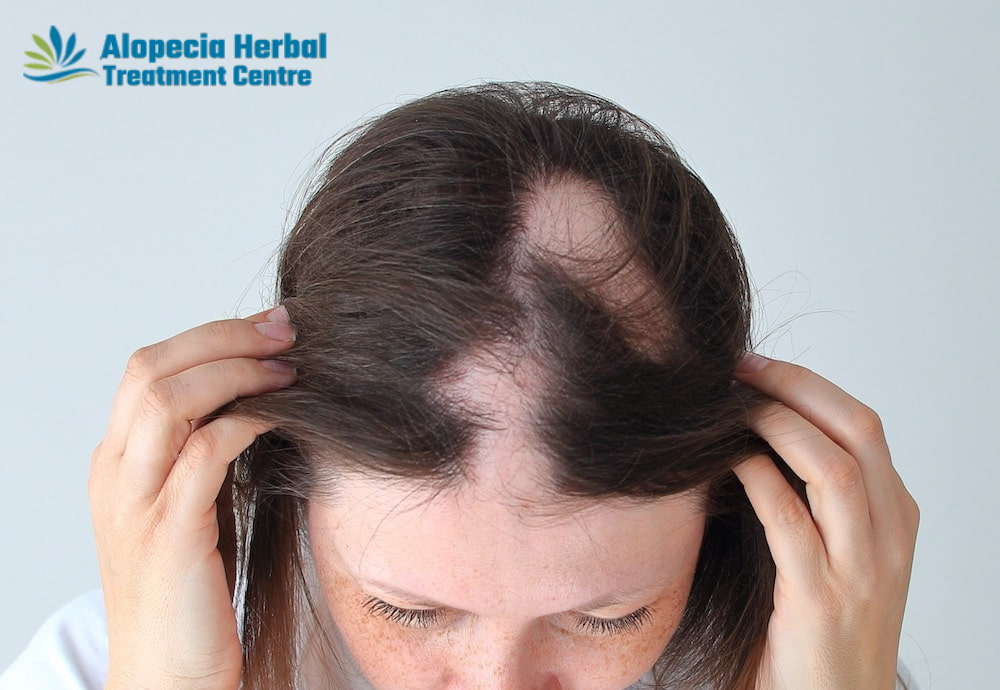 Trusted Hair Loss Treatment Clinic in Noida